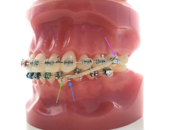 CLASS III Elastics: